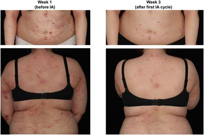 IgE-Selective Immunoadsorption for Severe Atopic Dermatitis